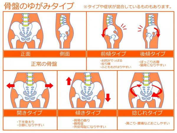 骨盤の歪みの種類とその症状 きちじ整体